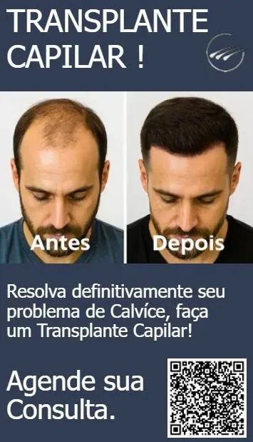 Transplante Capilar Goiânia — Antes e Depois · Dr. Gabriel Braga