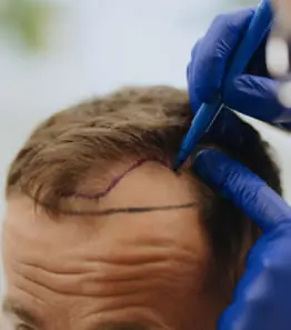 Transplante capilar FUE em Goiânia — implante de cabelo método MAX FUE, Dr. Gabriel Braga