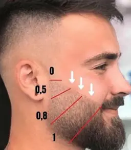 Transplante de barba FUE em Goiânia — correção de falhas e alta densidade, Dr. Gabriel Braga