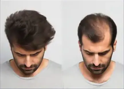 Resultado implante de cabelo Goiânia — antes e depois vista superior, alta densidade grafts Dr. Gabriel Braga